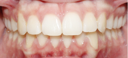 After image