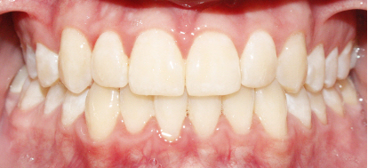 After image