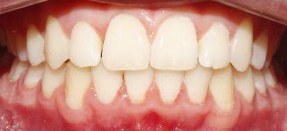After image