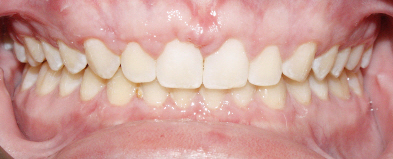 After image