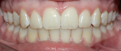 After image