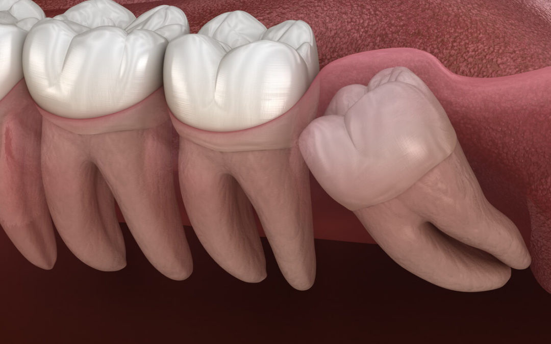 “Will my wisdom teeth make my teeth crooked?”
