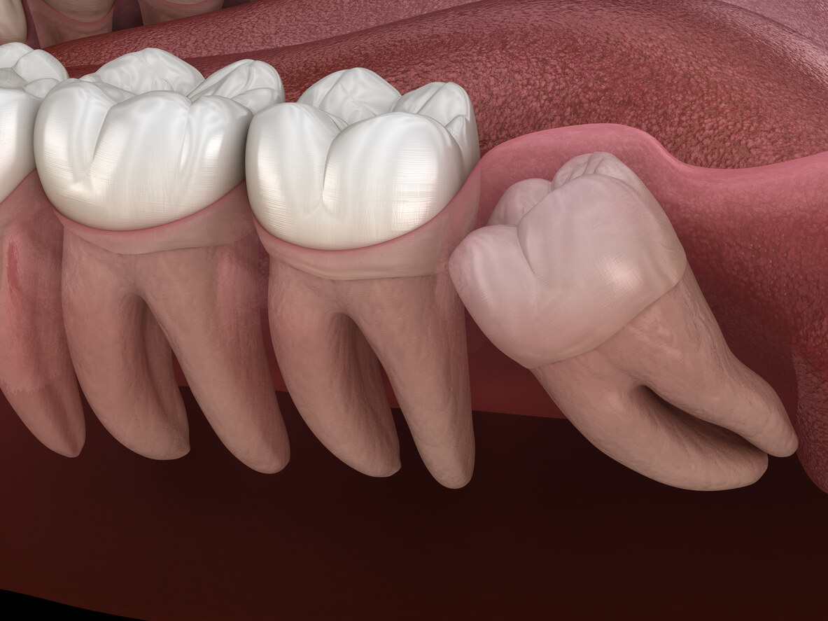Wisdom Teeth