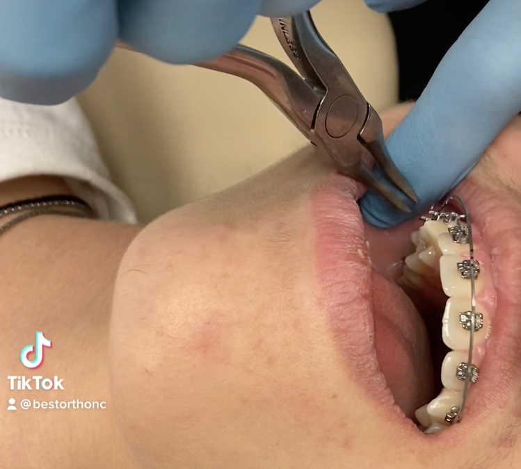 What does it mean to get my braces “tightened”?