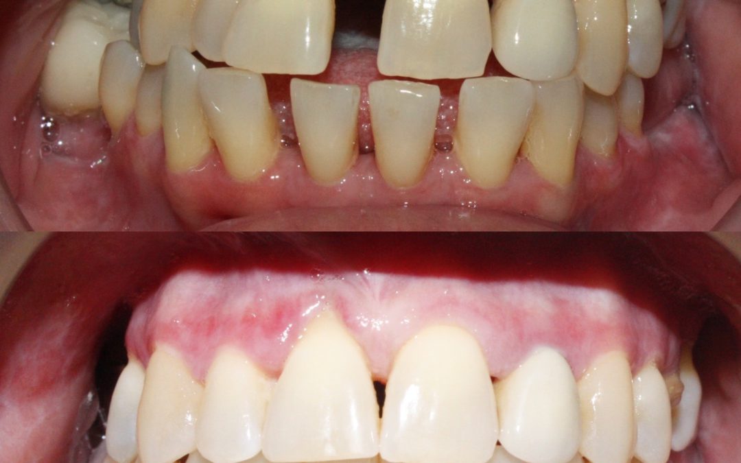 Can adults get orthodontic treatment?