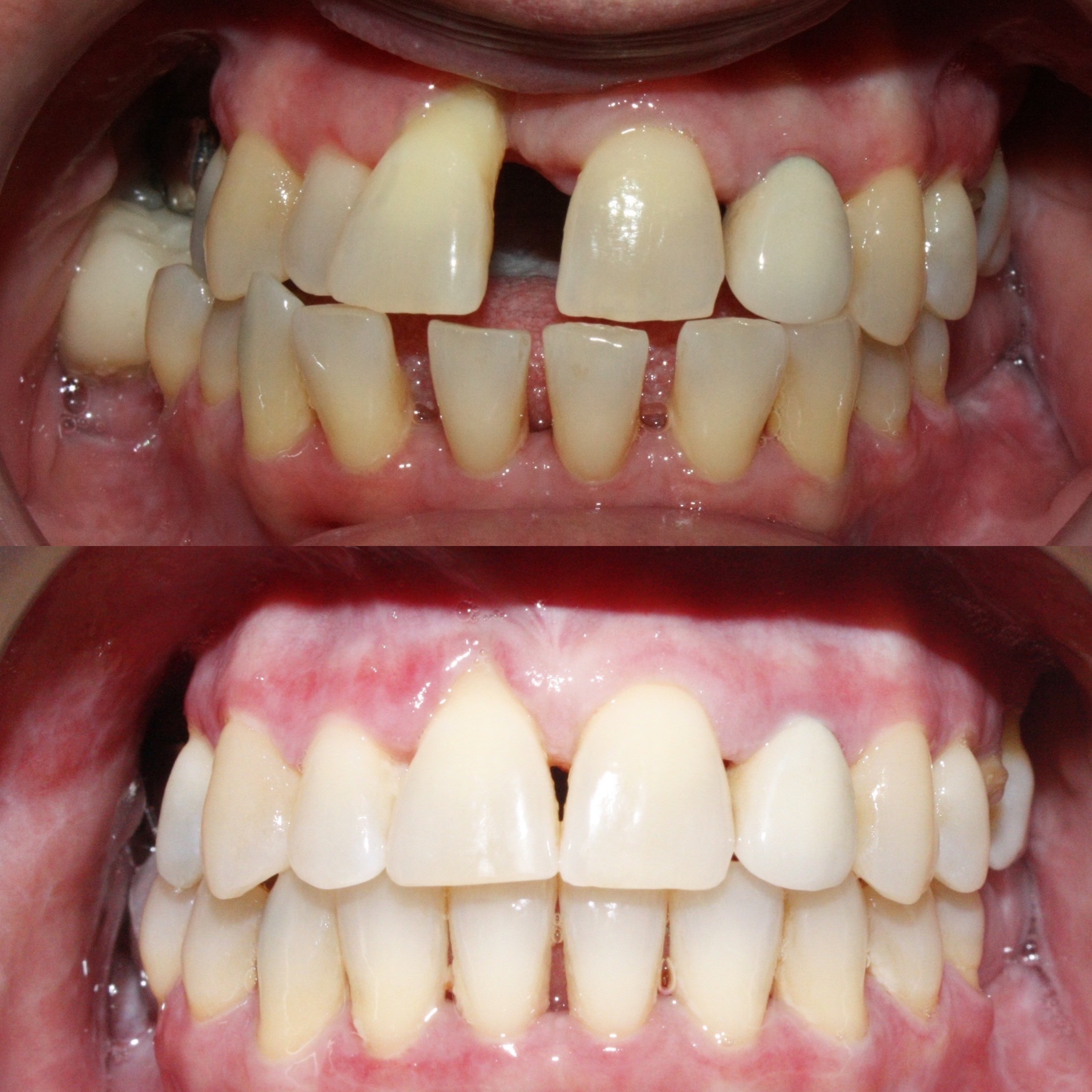 Adult Orthodontics