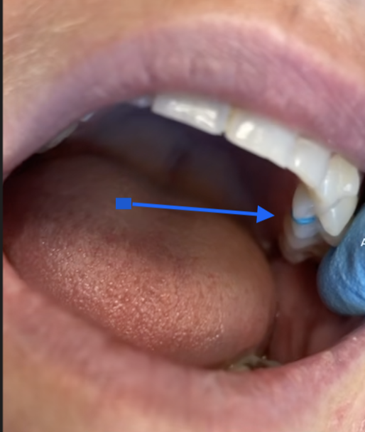 What are “seps,” separators, or spacers?