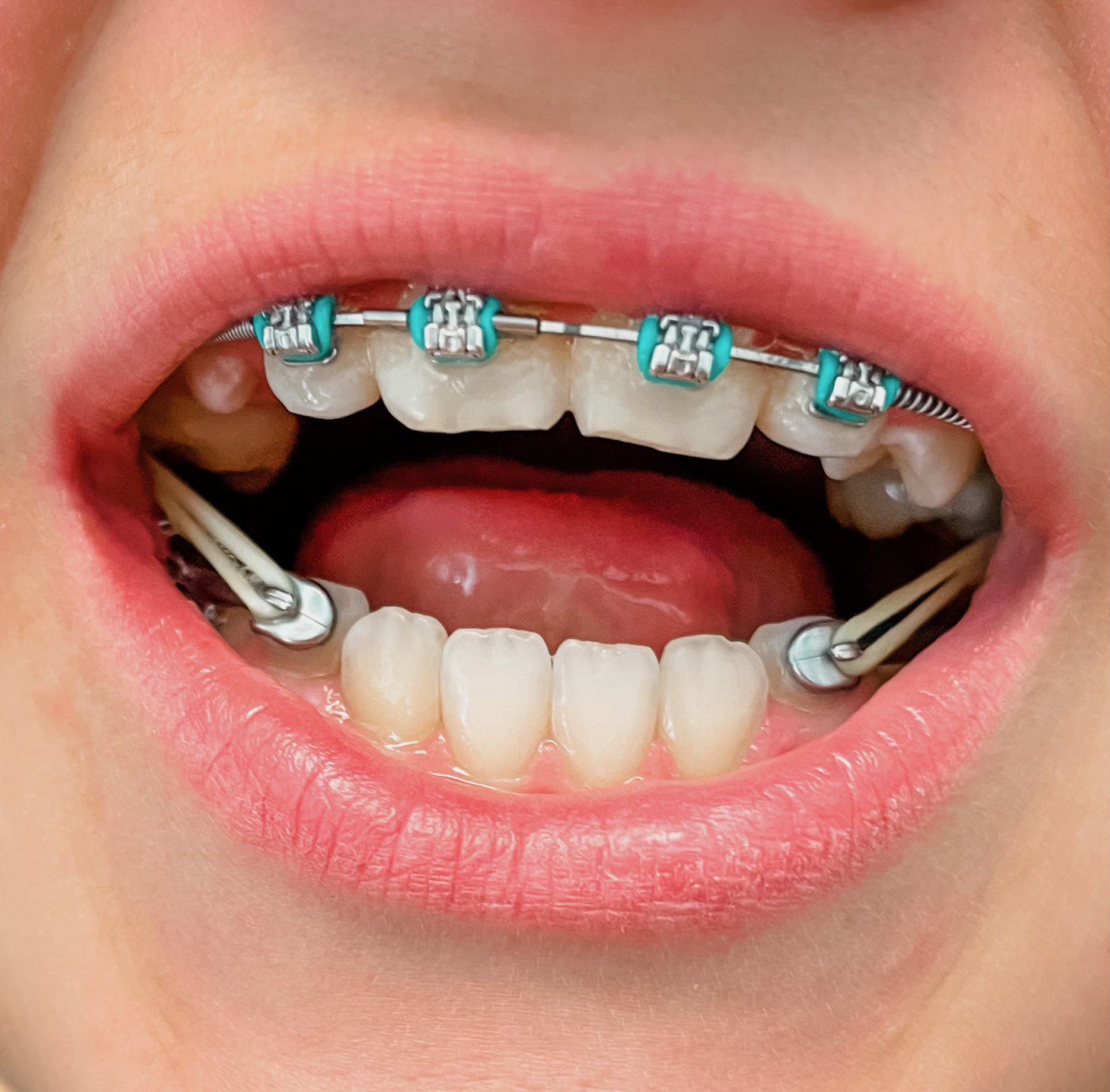 Elastics or rubber bands