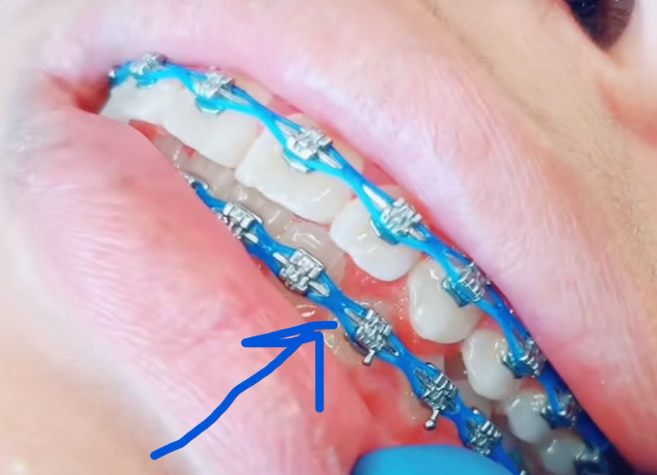 What is a tongue thrust?