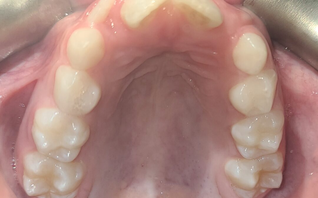 How Orthodontics Can Help Kids Sleep and Breathe Better