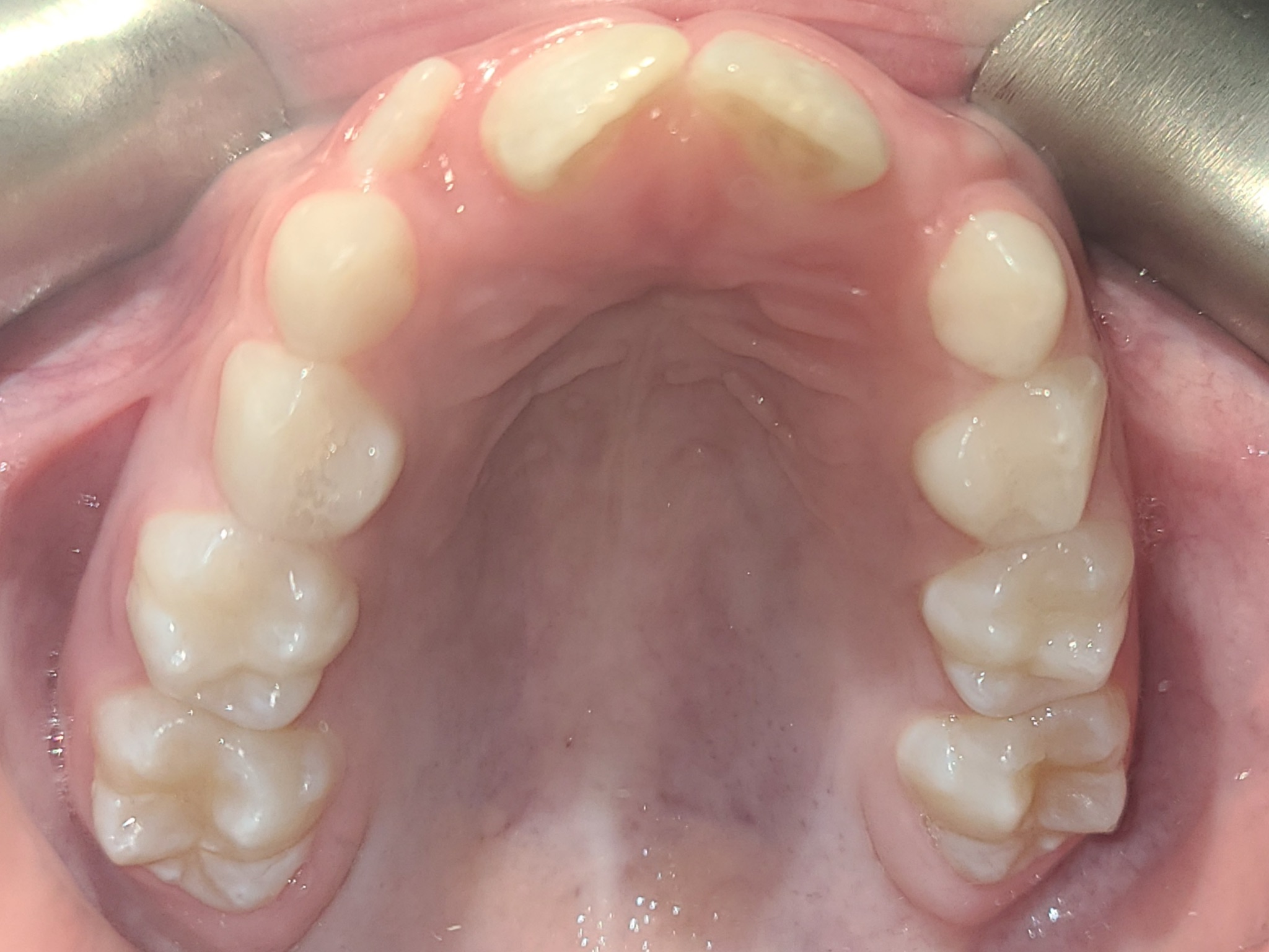 Narrow palate that needs expander
